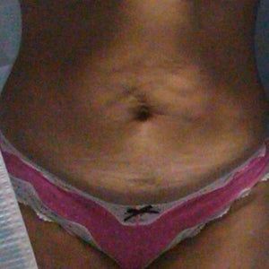 Có nên chọn tạo hình thành bụng mini để tránh sẹo dài?