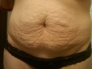 Ngoài tạo hình thành bụng mini, còn cách nào để cắt bỏ da và mỡ thừa?