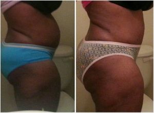 Có phải kỳ kinh nguyệt sắp tới và làm việc nhà nhẹ nhàng khiến tôi bị sưng đến mức này không? Tôi đã chính thức làm phẫu thuật thành bụng được 1 tháng