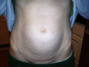 Tạo hình thành bụng mini có cho tôi kết quả như ý? Thời gian hồi phục là bao lâu?