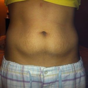 Cách chọn giữa tạo hình thành bụng mini và tạo hình thành bụng toàn phần?