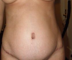 Năm tháng sau khi làm tạo hình thành bụng kèm hút mỡ, đôi lúc trông tôi như mang bầu 3 tháng