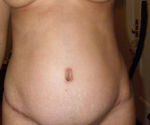 Năm tháng sau khi làm tạo hình thành bụng kèm hút mỡ, đôi lúc trông tôi như mang bầu 3 tháng