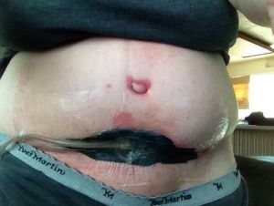 Phù nề có thể khiến tôi tăng cân không? Liệu rốn của tôi có lồi mãi thế này không?