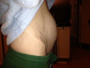 Tạo hình thành bụng mini có cho tôi kết quả như ý? Thời gian hồi phục là bao lâu?