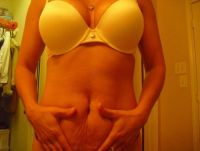 Da tôi có đủ chảy xệ để làm tạo hình thành bụng mini không?