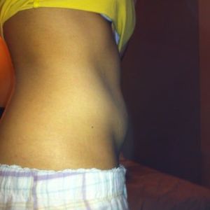 Cách chọn giữa tạo hình thành bụng mini và tạo hình thành bụng toàn phần?