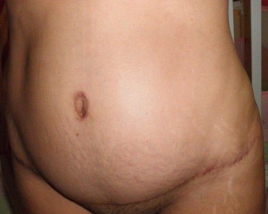 Năm tháng sau khi làm tạo hình thành bụng kèm hút mỡ, đôi lúc trông tôi như mang bầu 3 tháng