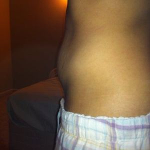 Cách chọn giữa tạo hình thành bụng mini và tạo hình thành bụng toàn phần?