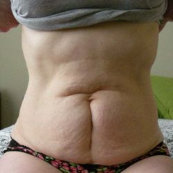 Có thể làm tạo hình thành bụng mini để trị sẹo dọc do mổ lấy thai không?