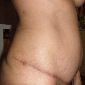 Năm tháng sau khi làm tạo hình thành bụng kèm hút mỡ, đôi lúc trông tôi như mang bầu 3 tháng