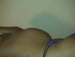 Em đã mổ lấy thai 2 lần, nên làm tạo hình thành bụng mini hay hút mỡ bằng laser SlimLipo?