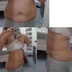 Không thể PT tạo hình thành bụng toàn phần do đã cắt túi mật. Vậy có thể tạo hình thành bụng mini không?