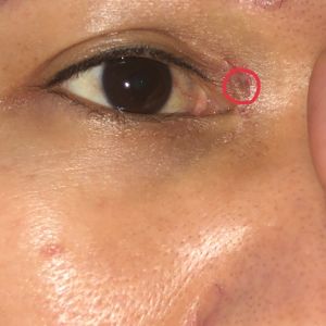 Bác sỹ cho em hỏi mắt em mở khoé mắt được 16 ngày thì em phát hiện lúc cắt chỉ bị sót ,nên em quay lại nơi cắt khoé lấy chỉ sót thì bạn cắt chỉ nhìn thấy chỉ nhưng do sâu quá bạn đấy làm nó tụt vào và mất dấu,vậy em hỏi nếu không lấy được chỉ thì em 