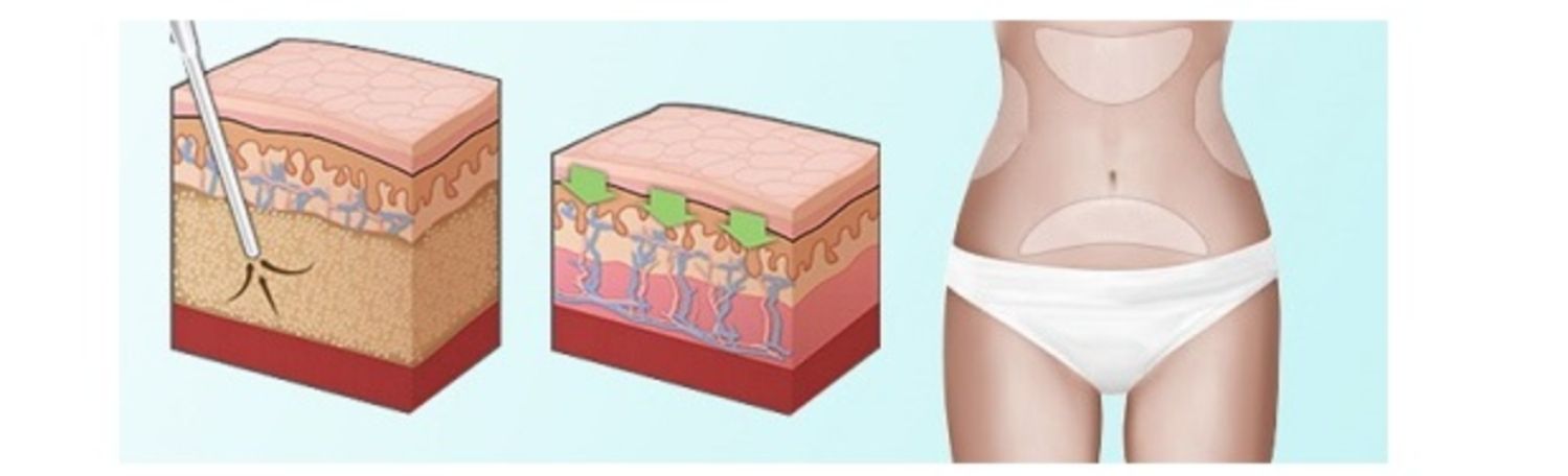 kết quả nâng mông
