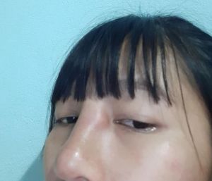 Nâng mũi rồi có bầu, bị sưng bầm và đau vùng gốc mũi giữa 2 mắt