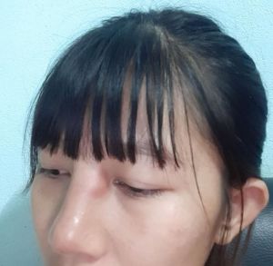 Nâng mũi rồi có bầu, bị sưng bầm và đau vùng gốc mũi giữa 2 mắt