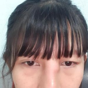 Nâng mũi rồi có bầu, bị sưng bầm và đau vùng gốc mũi giữa 2 mắt