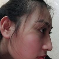 Nên nâng mũi hay chỉ cần mài gồ?