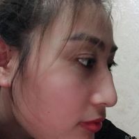 Nên nâng mũi hay chỉ cần mài gồ?