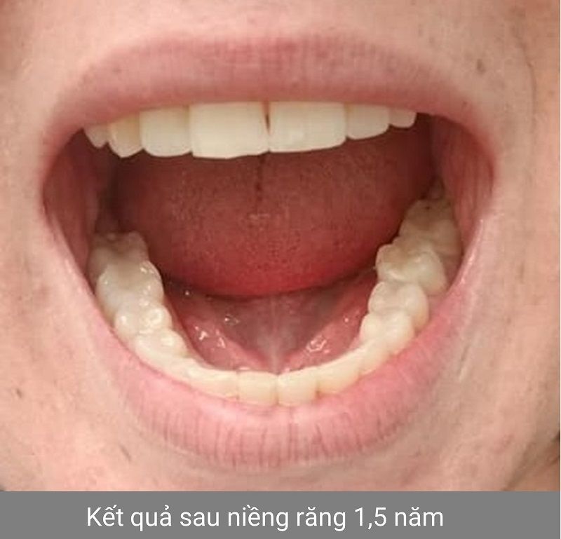 Hình ảnh niềng răng - Bác sĩ Phạm Sơn - Ca 01