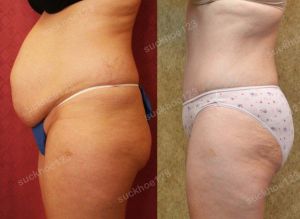 Tạo hình thành bụng kết hợp khắc phục thoát vị bụng, nữ 45 tuổi - ca 16