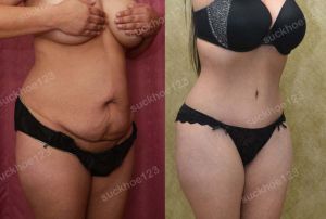 Tạo hình thành bụng, nữ 31 tuổi - ca 13