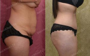 Tạo hình thành bụng, nữ 31 tuổi - ca 13