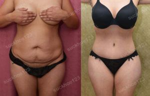 Tạo hình thành bụng, nữ 31 tuổi - ca 13