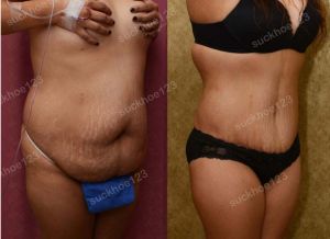 Tạo hình thành bụng, nữ 38 tuổi - ca 14