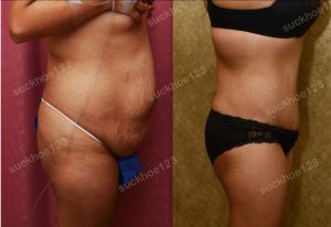 Tạo hình thành bụng, nữ 38 tuổi - ca 14