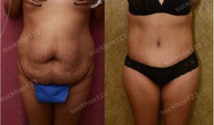 Tạo hình thành bụng, nữ 38 tuổi - ca 14