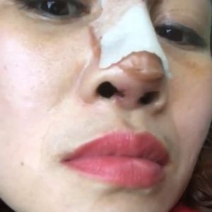 Nâng mũi 7 ngày nặn ra ít mủ ở mối chỉ khâu