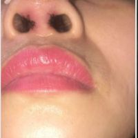 Nâng mũi 7 ngày nặn ra ít mủ ở mối chỉ khâu