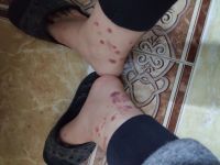 chữa sẹo viêm mao mạch hoại tử