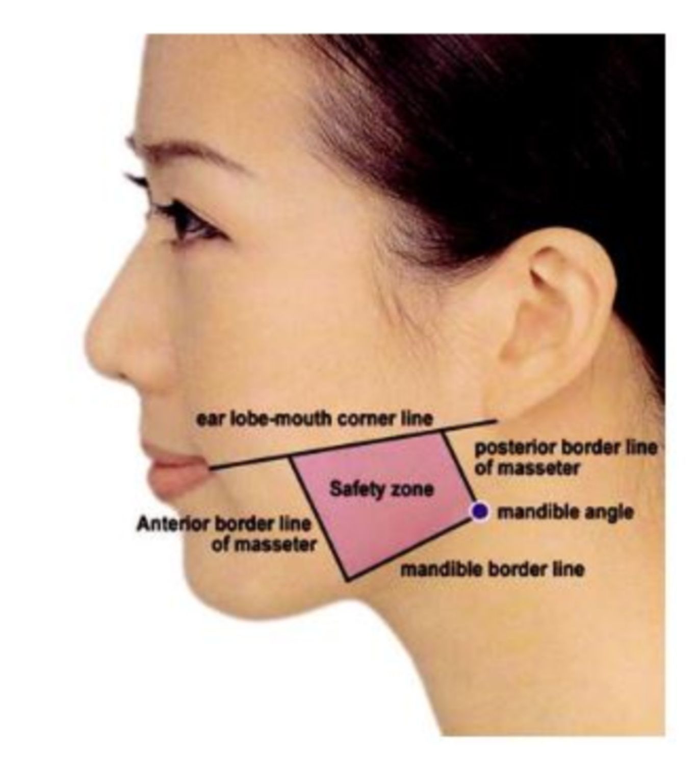 vung an toan tiem botox