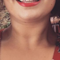 Mặt biến dạng sau khi tiêm Botox góc hàm