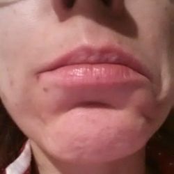 Các cơ quanh khóe miệng có hồi phục sau khi bị tê liệt do botox không?