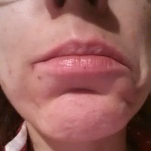 Các cơ quanh khóe miệng có hồi phục sau khi bị tê liệt do botox không?