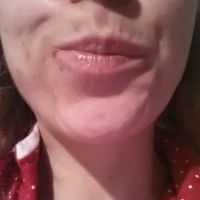 Các cơ quanh khóe miệng có hồi phục sau khi bị tê liệt do botox không?