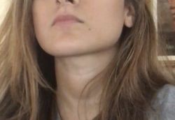 Trường hợp của tôi thì cần bao nhiêu đơn vị botox để thu nhỏ cơ cắn, tạo mặt v-line?