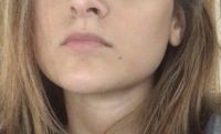 Trường hợp của tôi thì cần bao nhiêu đơn vị botox để thu nhỏ cơ cắn, tạo mặt v-line?