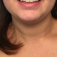 Mặt biến dạng sau khi tiêm Botox góc hàm