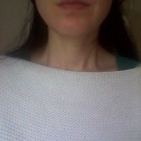 Bị liệt cơ vĩnh viễn sau hơn 2 năm tiêm botox gọn hàm?