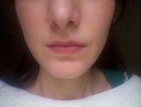 Bị liệt cơ vĩnh viễn sau hơn 2 năm tiêm botox gọn hàm?