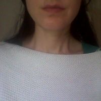 Bị liệt cơ vĩnh viễn sau hơn 2 năm tiêm botox gọn hàm?