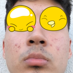 Tôi có nên tiêm Botox góc hàm để thu giảm cơ cắn không và quy trình này thường có giá bao nhiêu?