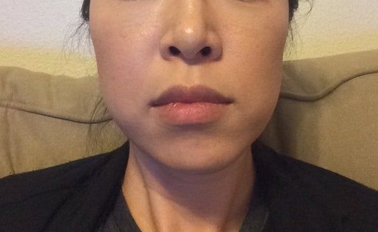 Tiêm botox góc hàm liệu có giúp cải thiện tình trạng bất cân đối trên khuôn mặt của tôi không?