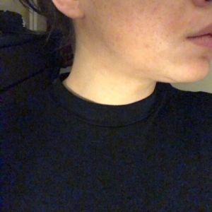 Xuất hiện cằm đôi và bị mất nét đường viền hàm sau tiêm botox gọn hàm