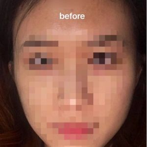 Hóp thái dương sau tiêm botox góc hàm